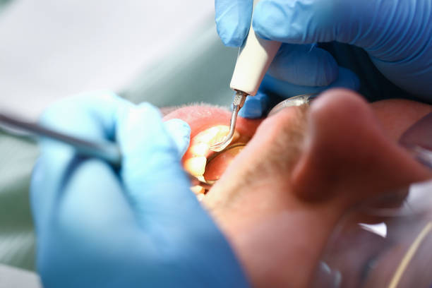 Best Emergency Dental Care for Broken or Chipped Teeth in Simpson, PA