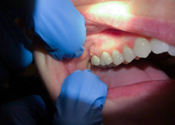 Best Emergency Wisdom Teeth Removal in Simpson, PA